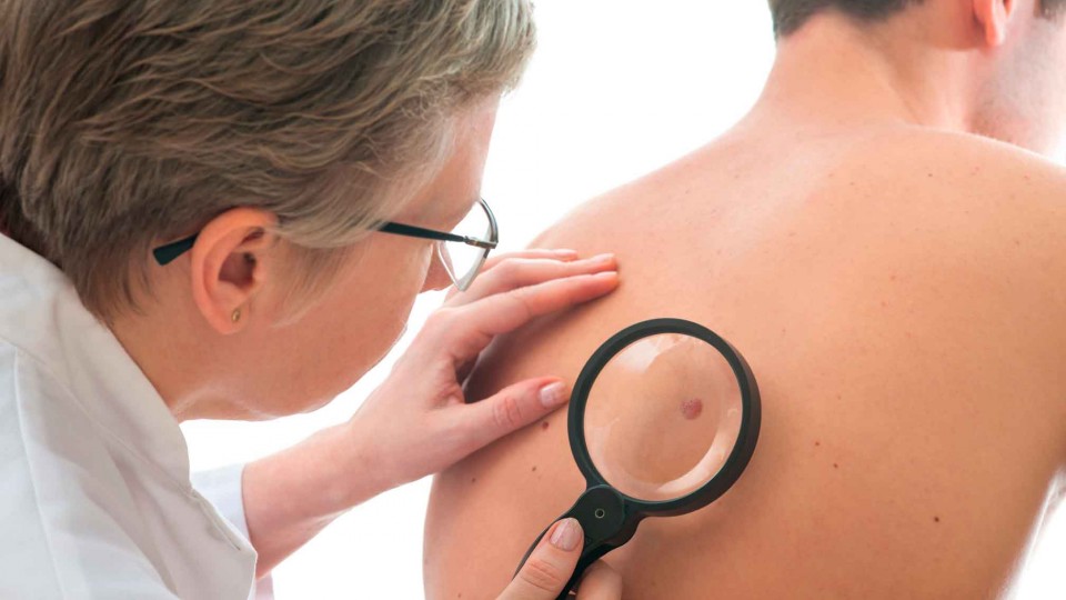 Mohs surgery (Skin cancer)